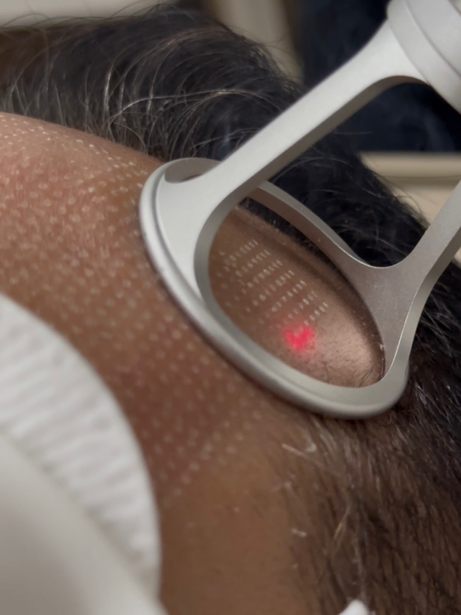 ‏Laser Skin Rejuvenation